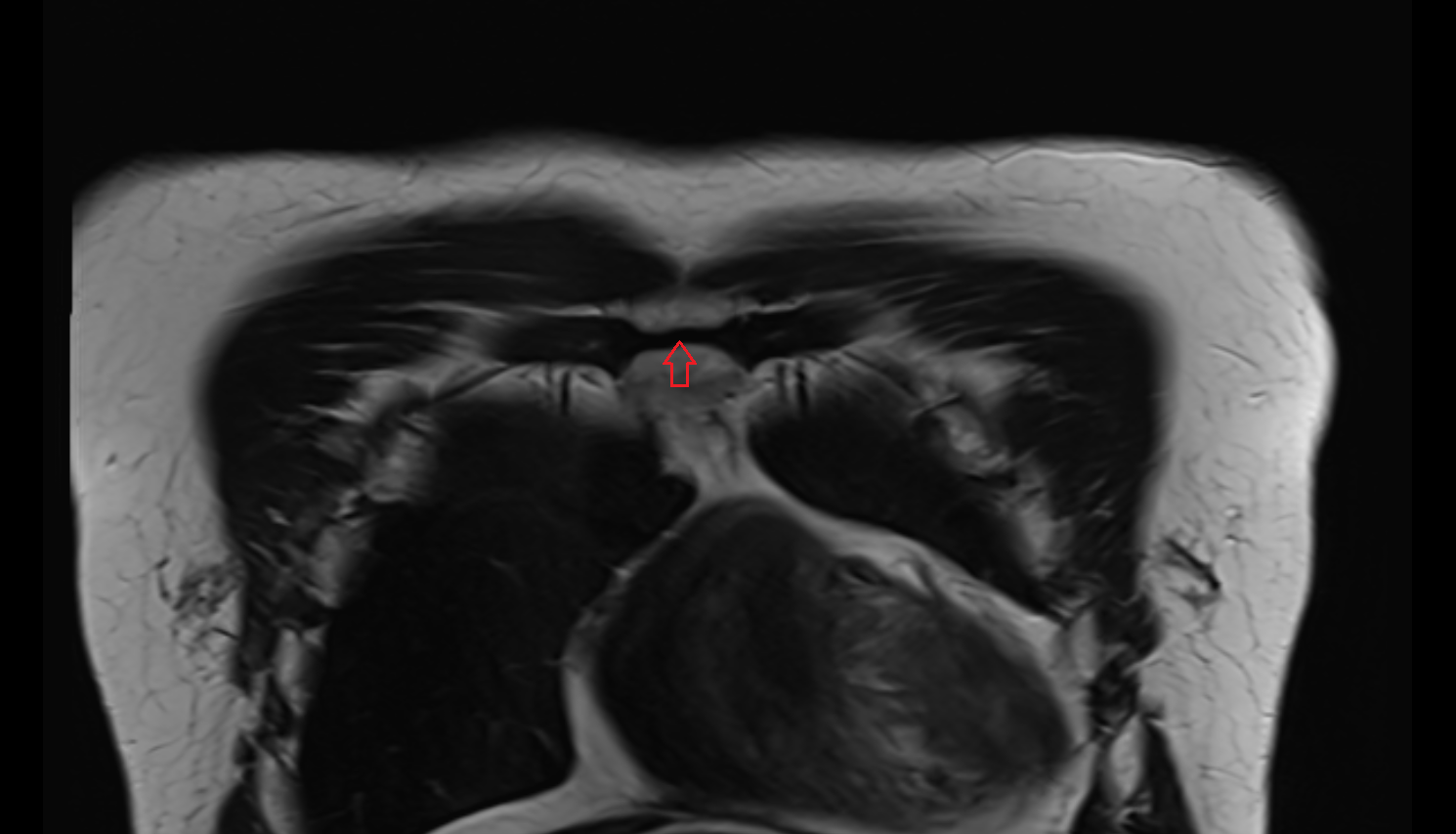 Sternal angle coronal MRI  image-img-00000-00000