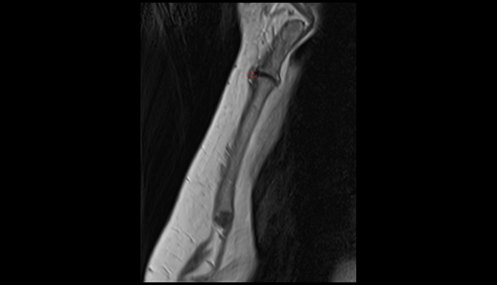 Sternal angle sag image
