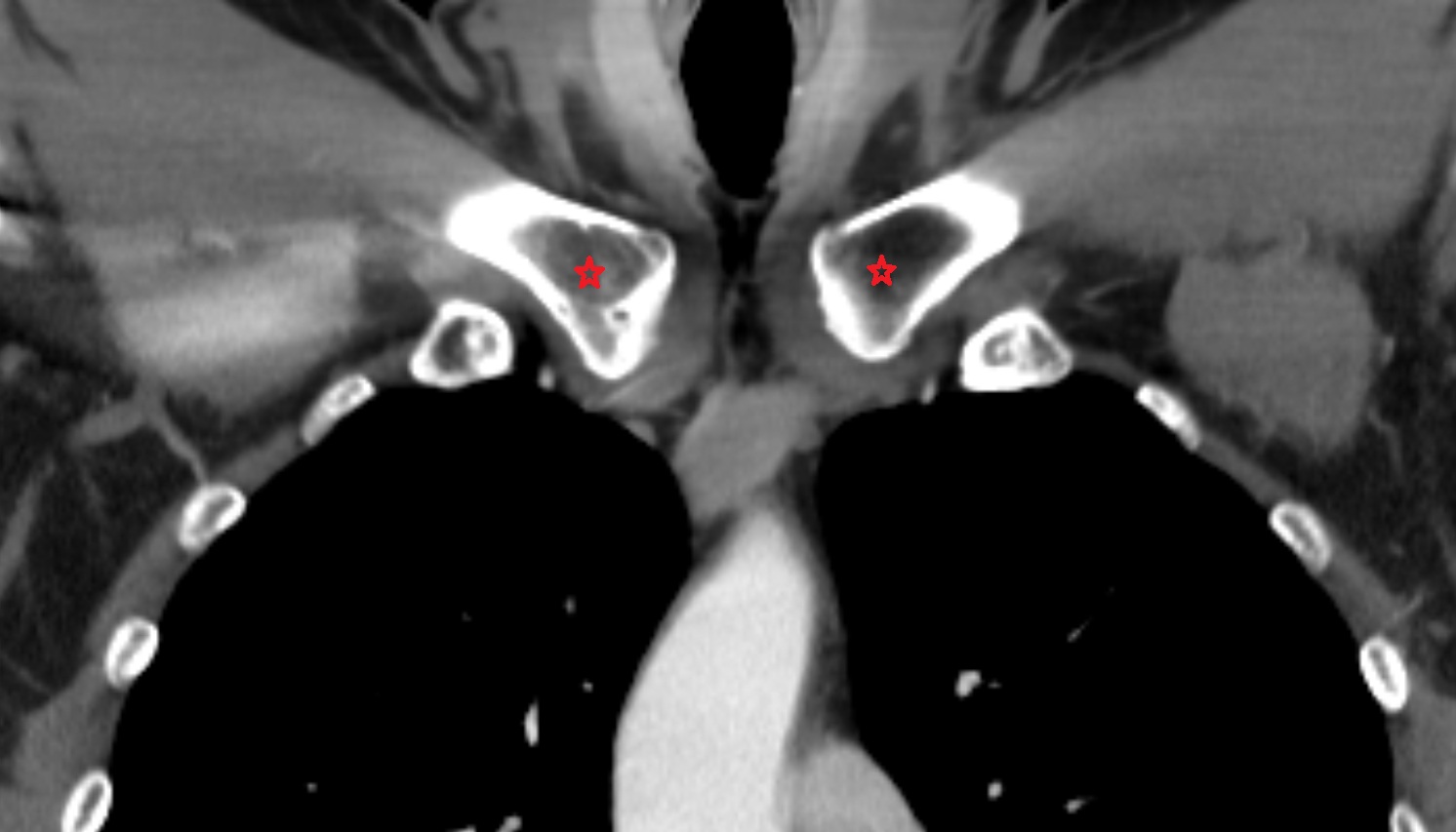 Sternal end of the clavicle  anatomy CT CORONAL  image -img-00000-00000