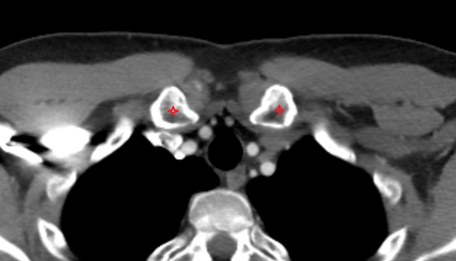Sternal end of the clavicle  anatomy CT axial  image -img-00000-00000