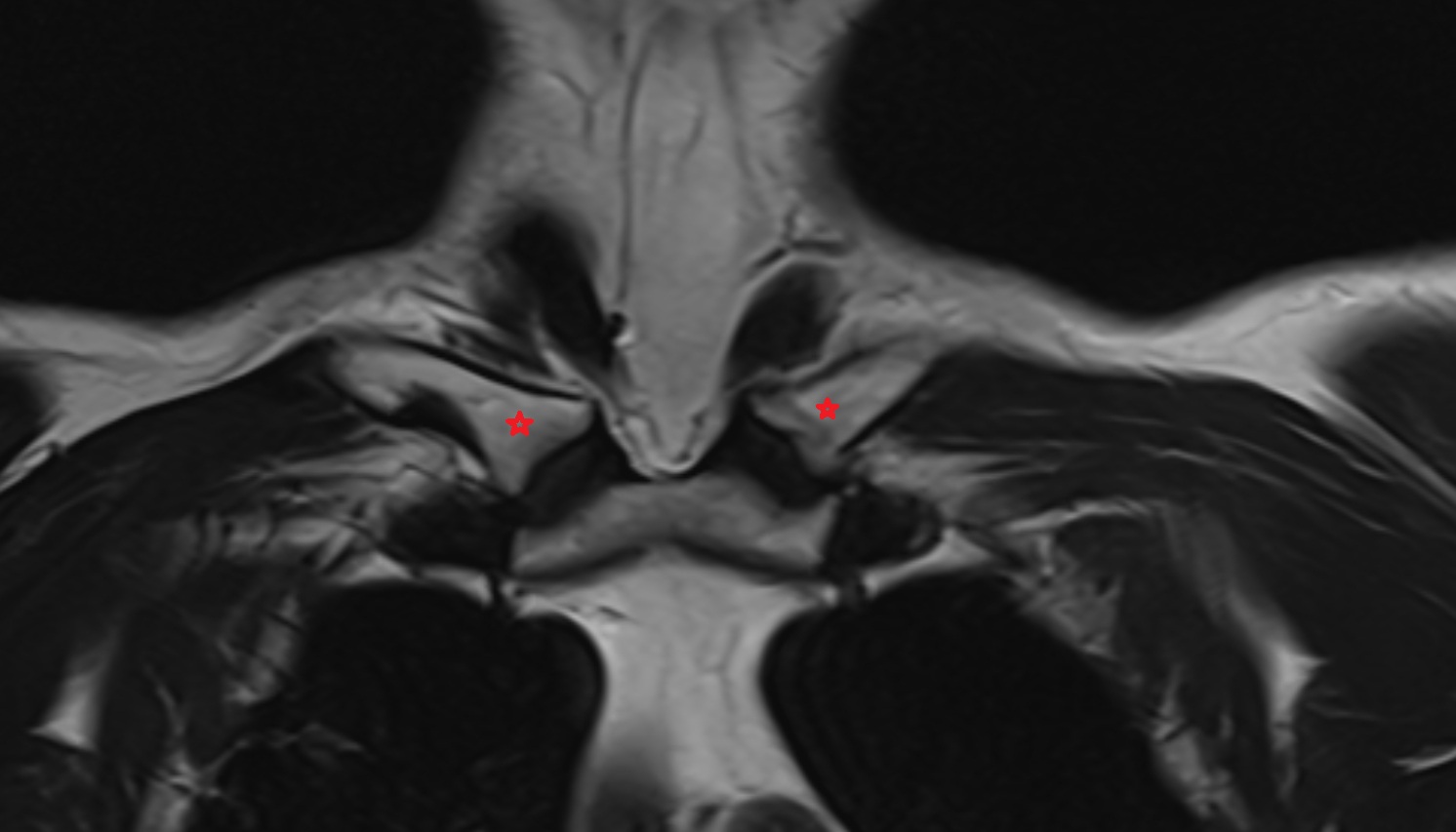 Sternal end of the clavicle  anatomy MRI CORONAL  image -img-00000-00000
