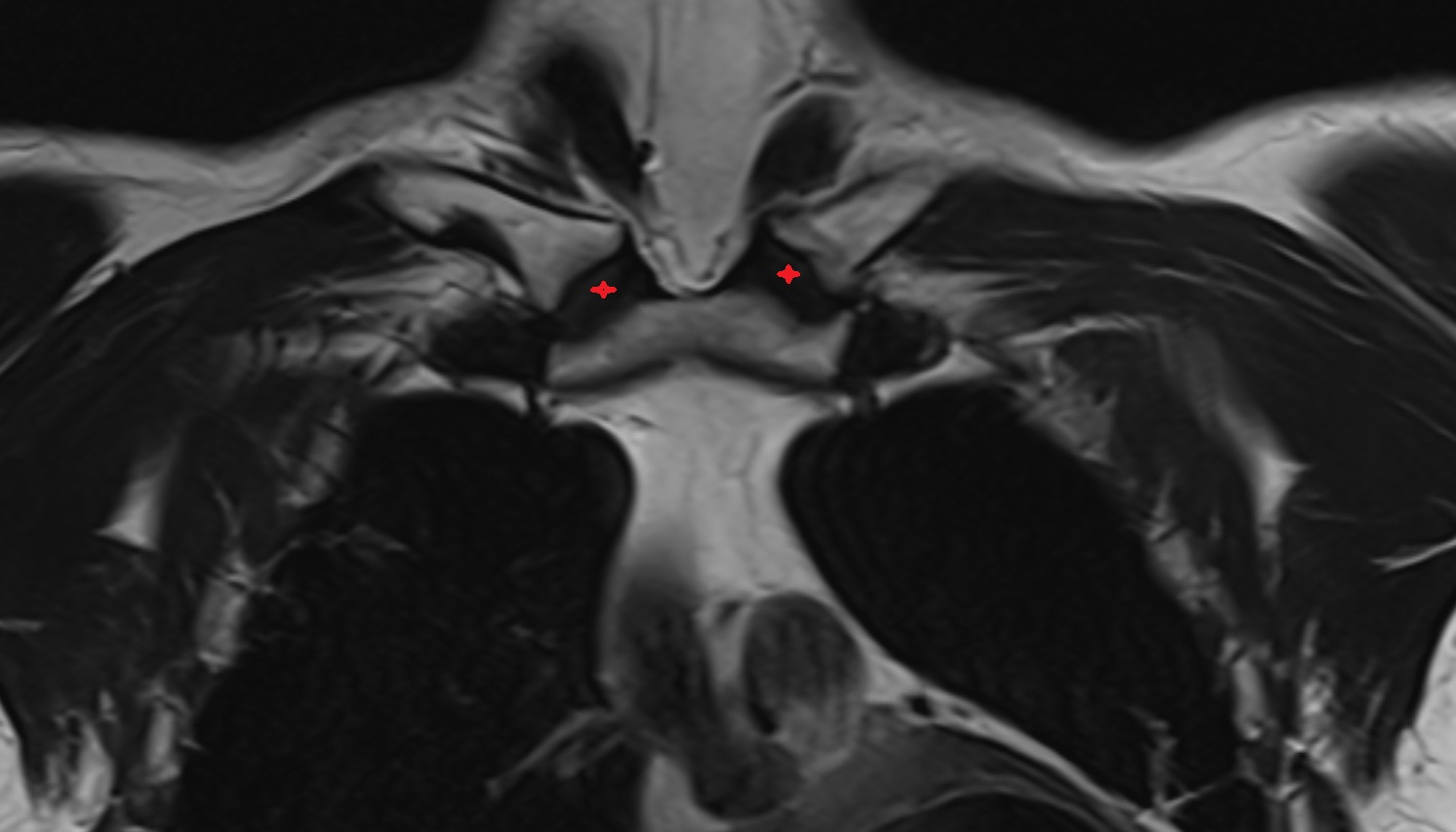 Sternoclavicular joint anatomy MRI coronal  image -img-00000-00000