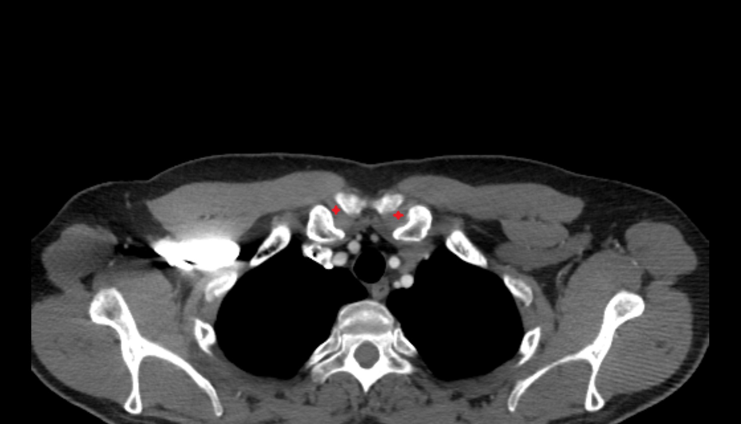 Sternoclavicular joint anatomy ct axial  image -img-00000-00000