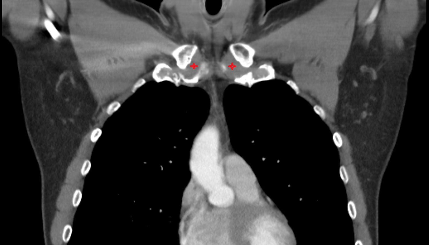Sternoclavicular joint anatomy ct coronal  image -img-00000-00000