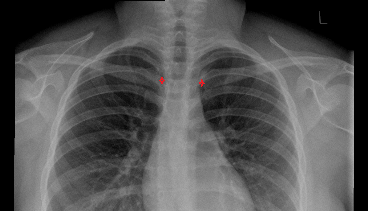 Sternoclavicular joint x ray Anatomy, Location and Imaging Appearance  -img-00000-00000