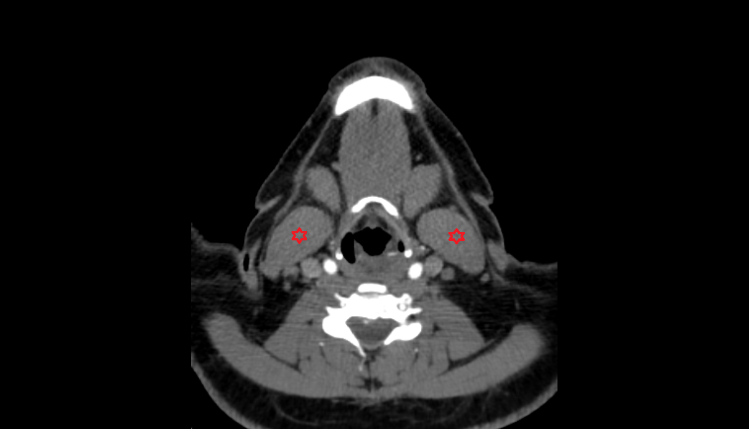 Sternocleidomastoid muscle CT axial  image-img-00000-00000