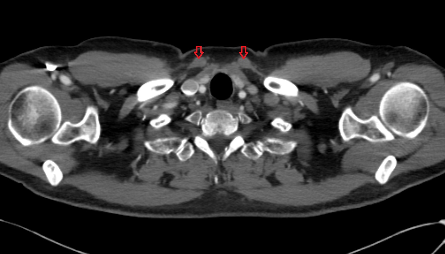 Sternocleidomastoid muscle   anatomy CT  axial  image -img-00000-00000