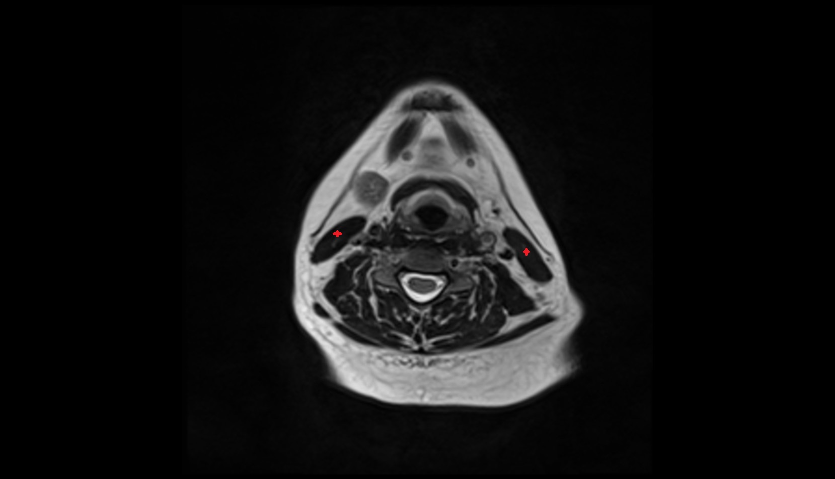 Sternocleidomastoid muscle mri axial image