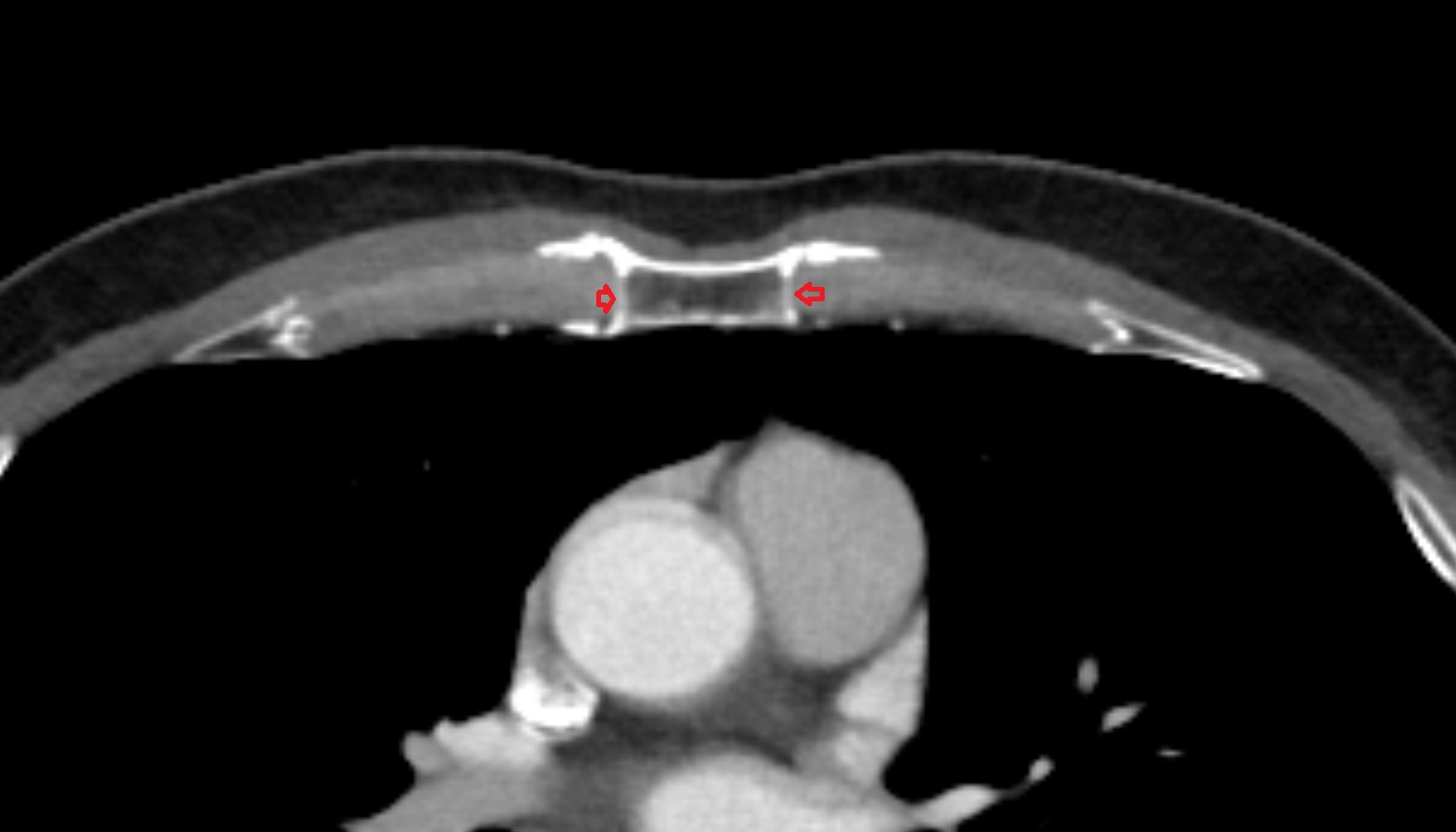 Sternocostal joint  anatomy CT AXIAL  image -img-00000-00000