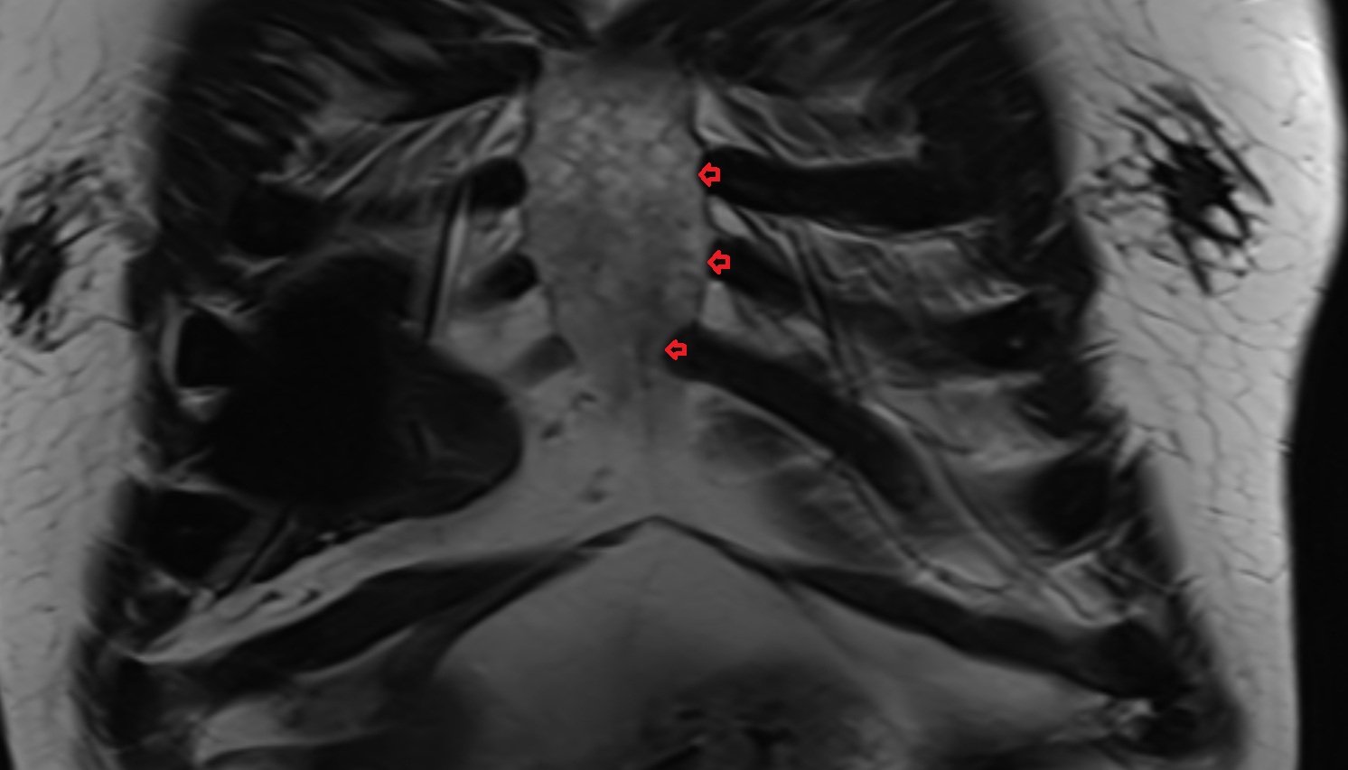 Sternocostal joint  anatomyMRI coronal  image -img-00000-00000