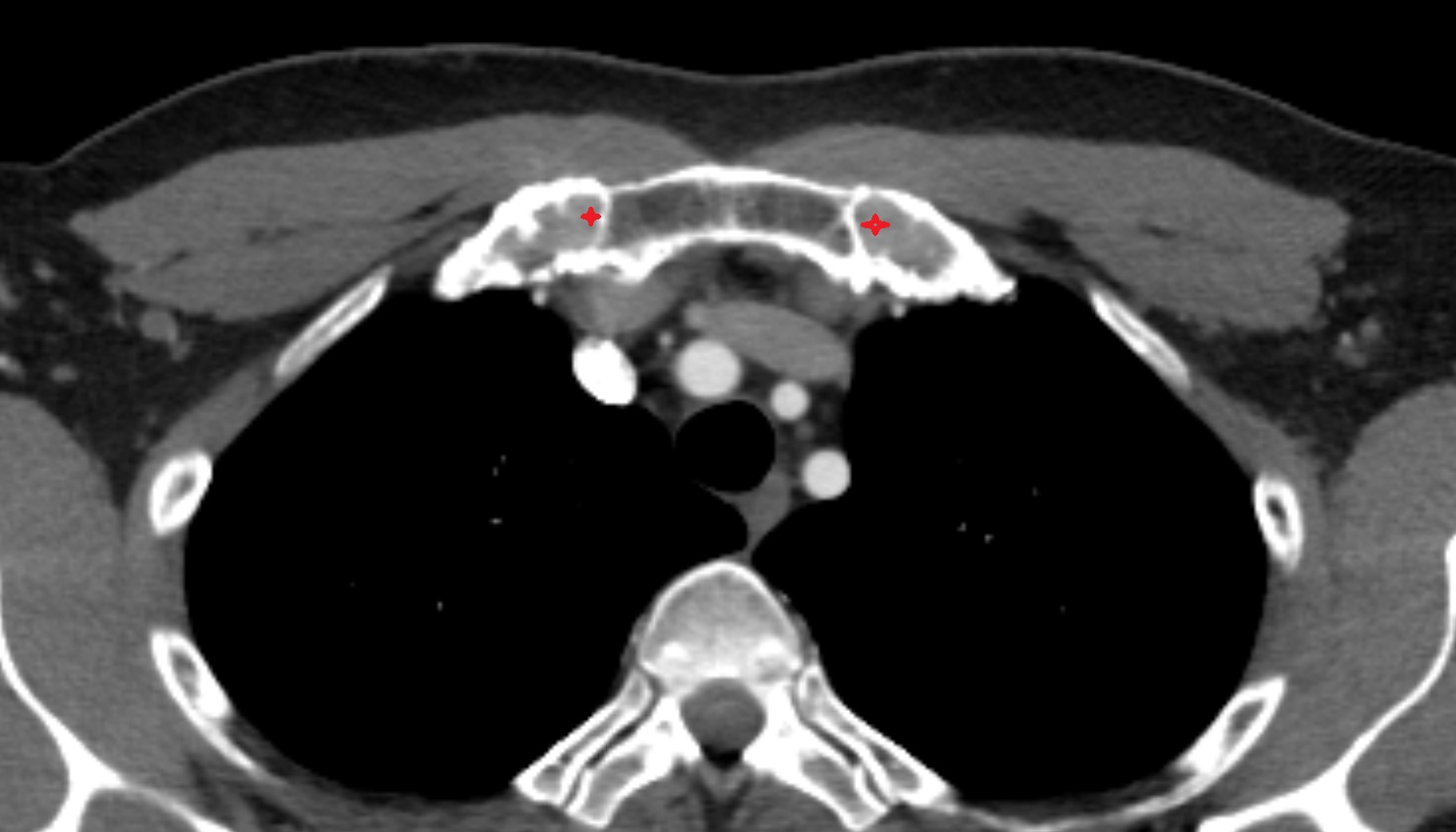 Sternocostal synchondrosis of first rib  anatomy CT AXIAL  image -img-00000-00000