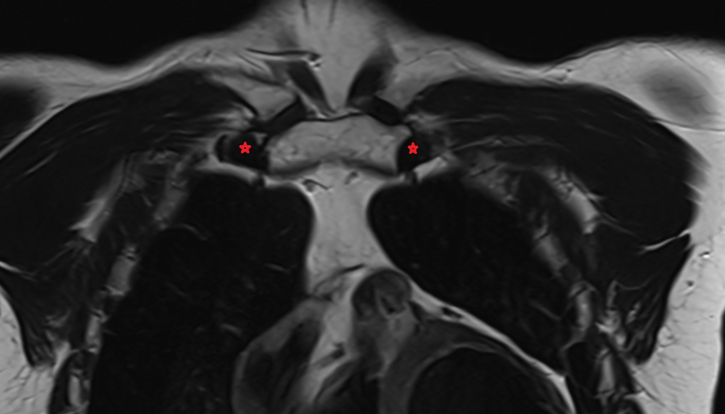 Sternocostal synchondrosis of first rib  anatomy MRI coronal  image -img-00000-00000