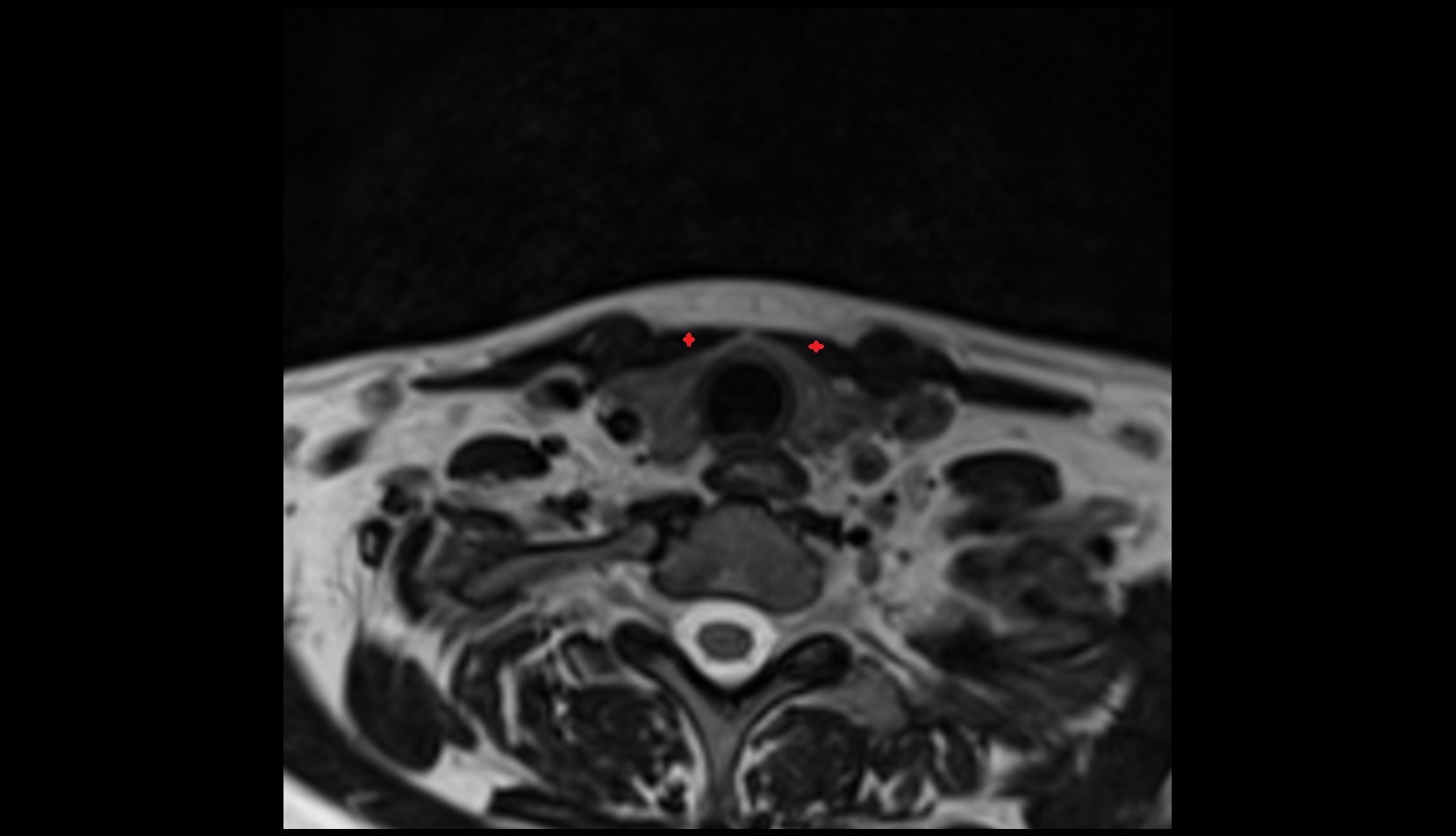 Sternohyoid muscle axial mri image