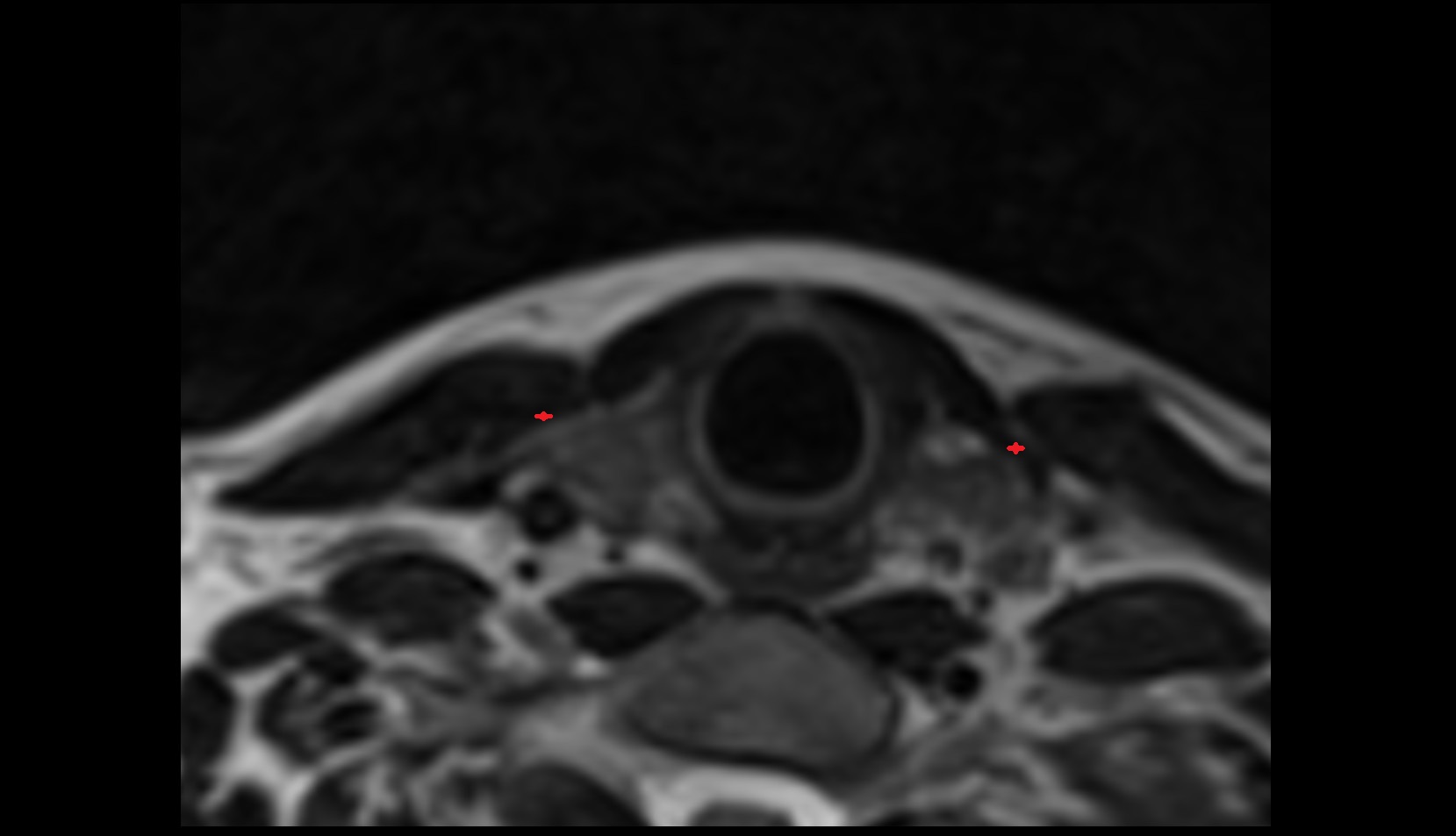 Sternothyroid muscle axial mri image