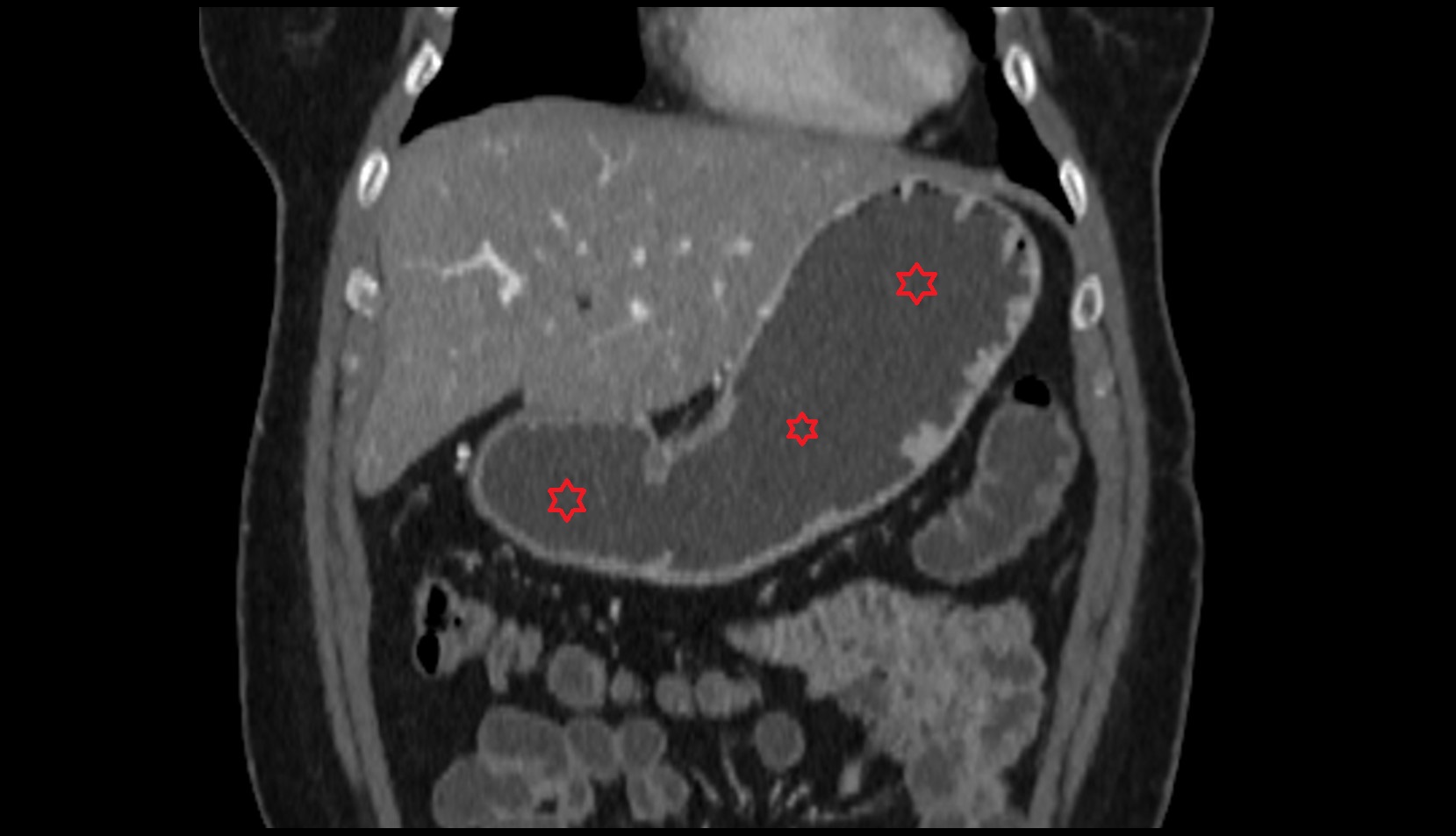 Stomach CT coronal image