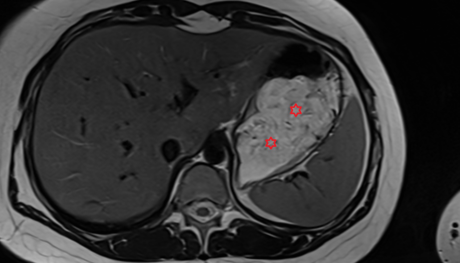Stomach MRI AXIAL anatomy  image -img-00000-00000