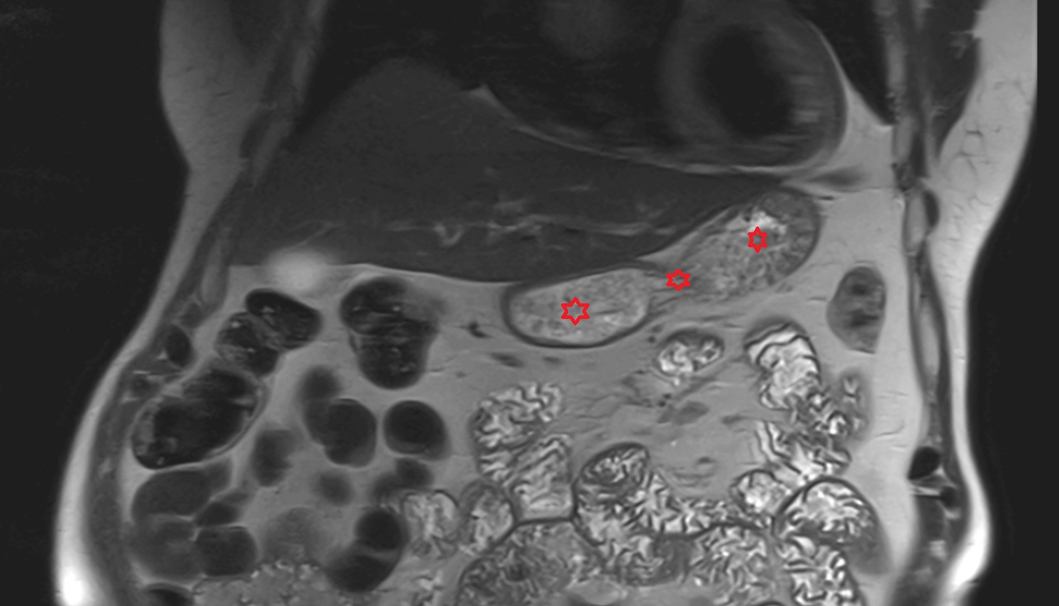 Stomach MRI coronal anatomy  image -img-00000-00000