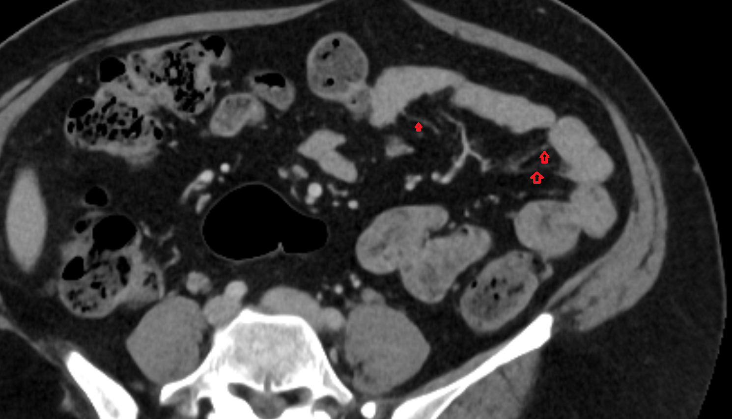 Straight Arteries CT axial  image-img-00000-00000