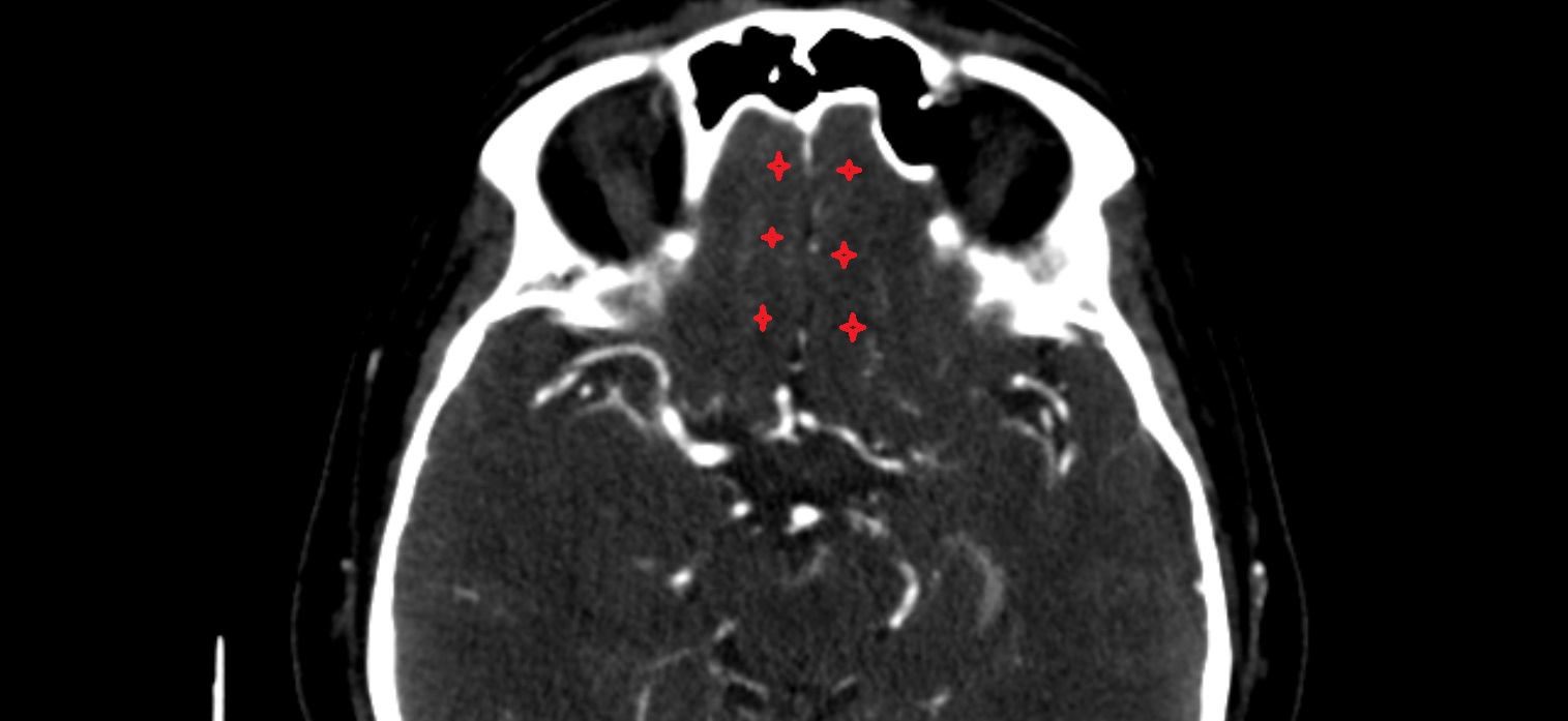 Straight gyrus  CT axial  cross sectional anatomy radiology image -img-00001-00001