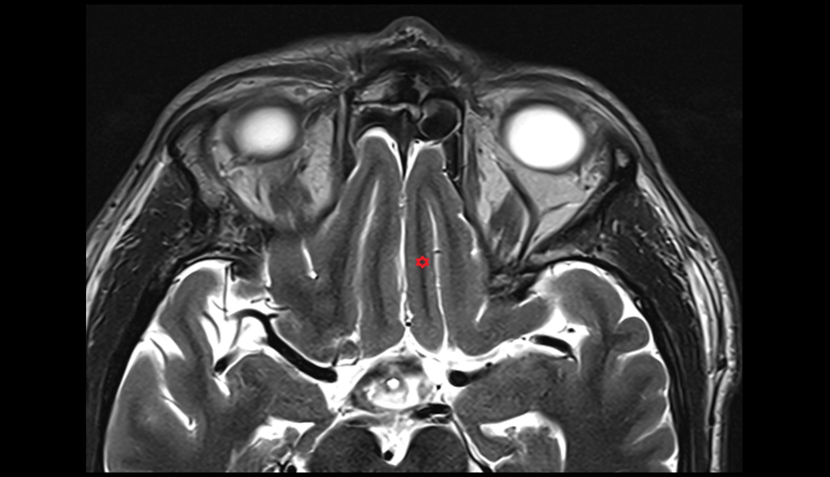 Straight gyrus MRI 3T axial image