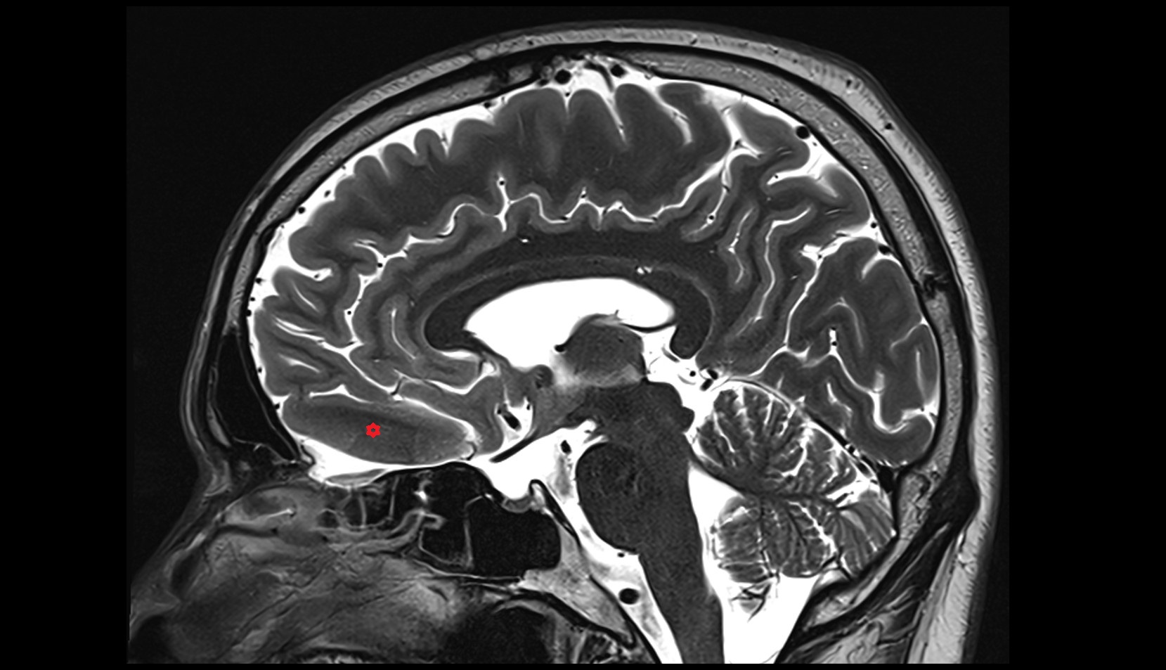 Straight gyrus MRI 3T sagittal image