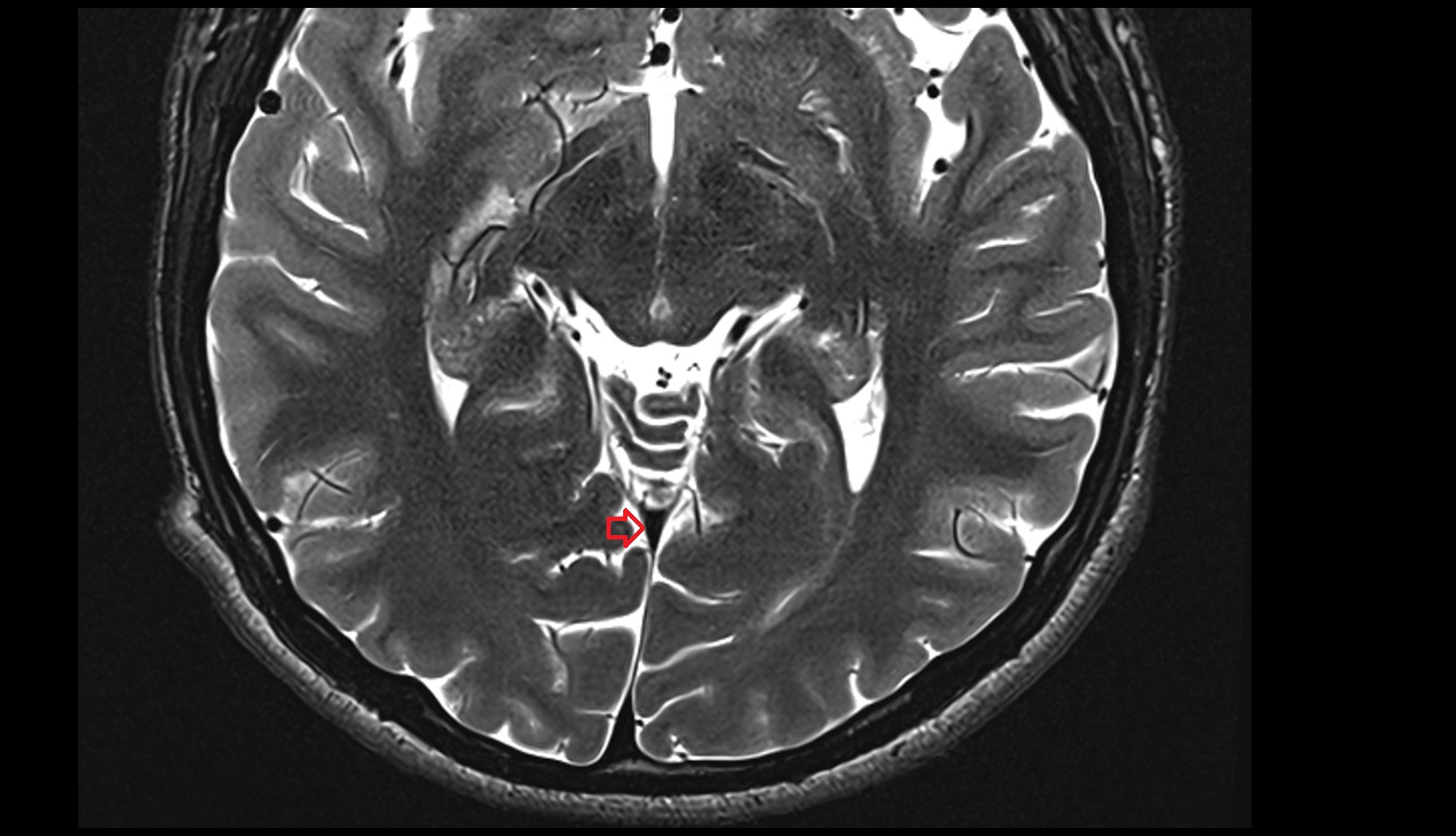Straight sinus MRI 3Taxial image