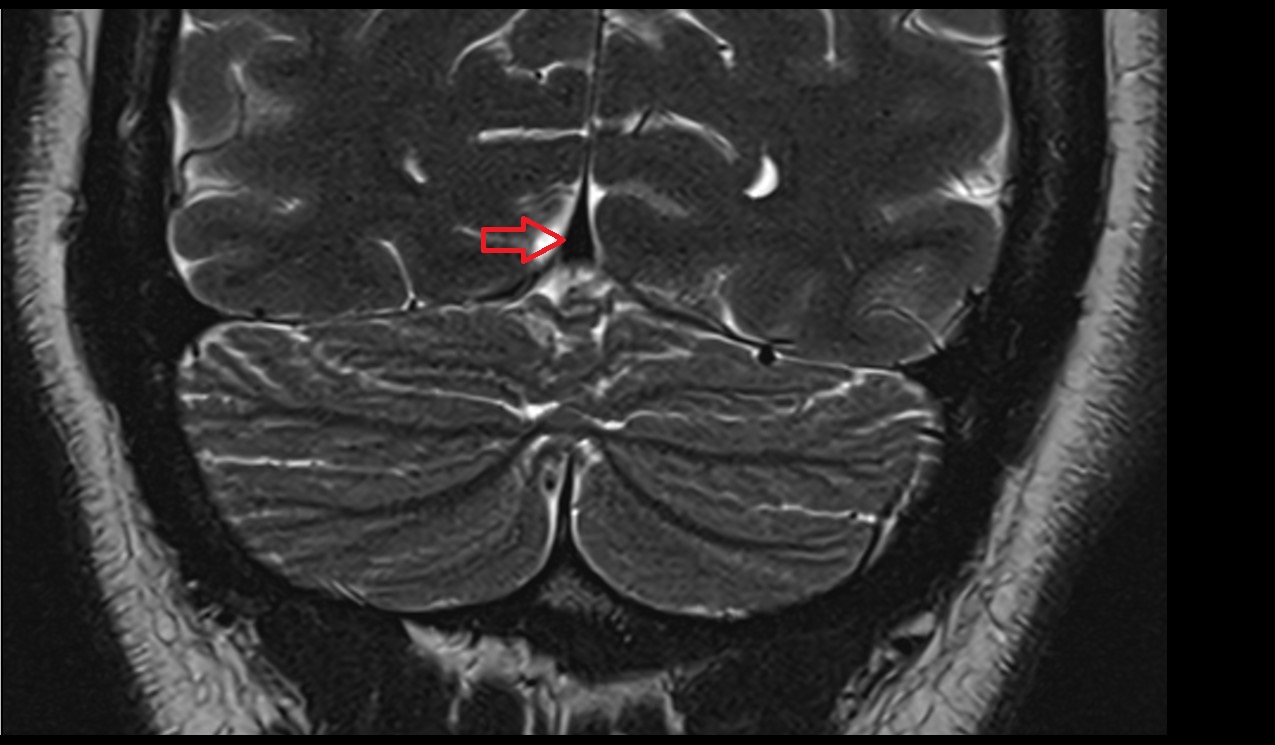 Straight sinus MRI 3T coronal image