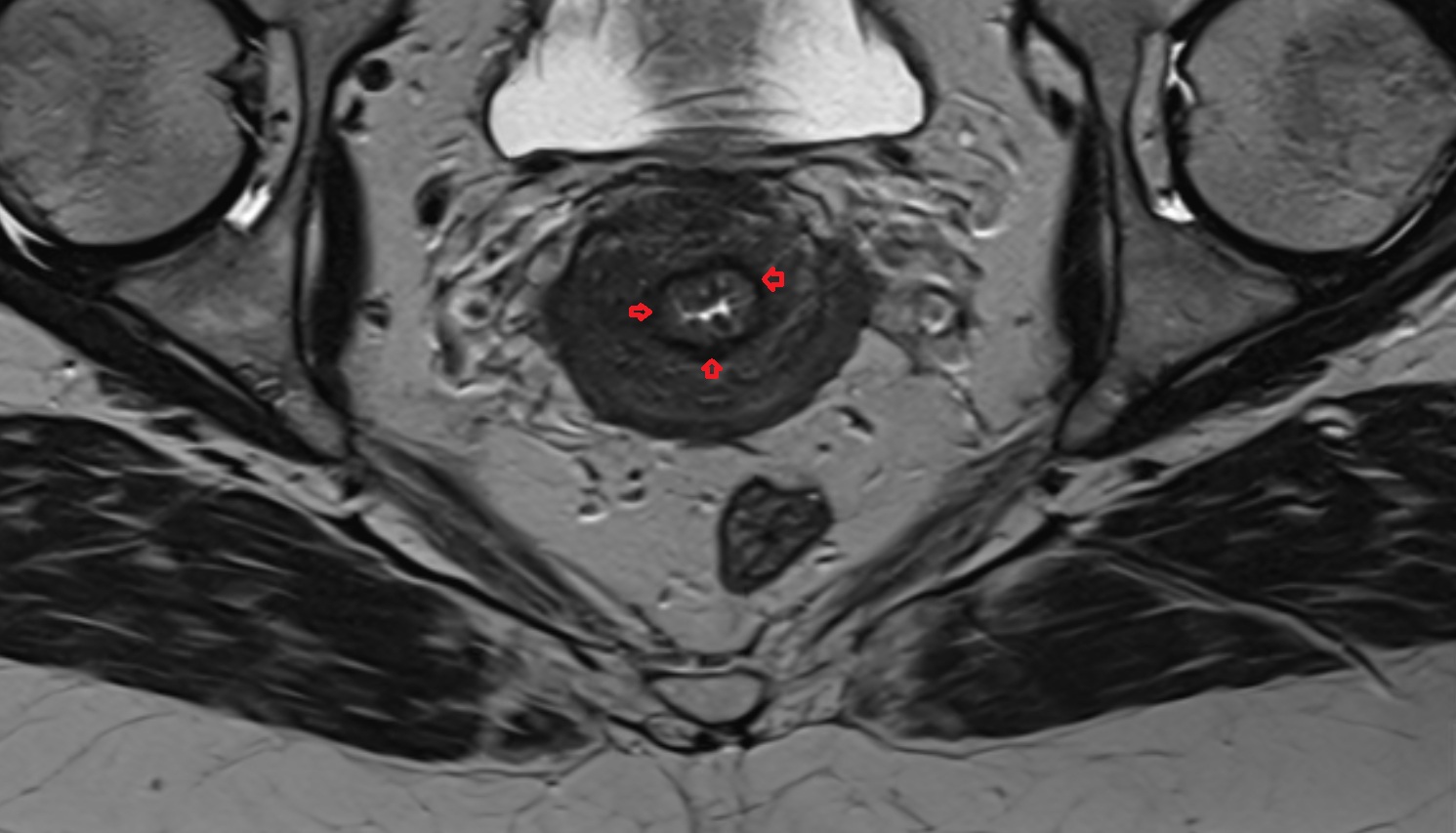Stroma of the cervix  MRI axial  anatomy  image-img-00000-00000