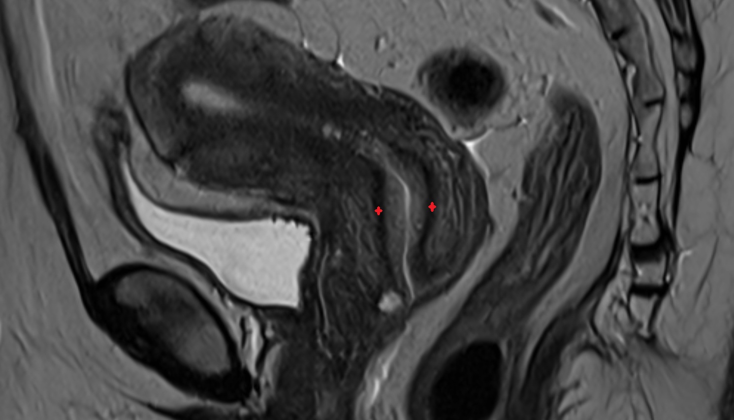 Stroma of the cervix  MRI sagittal  anatomy  image-img-00000-00000