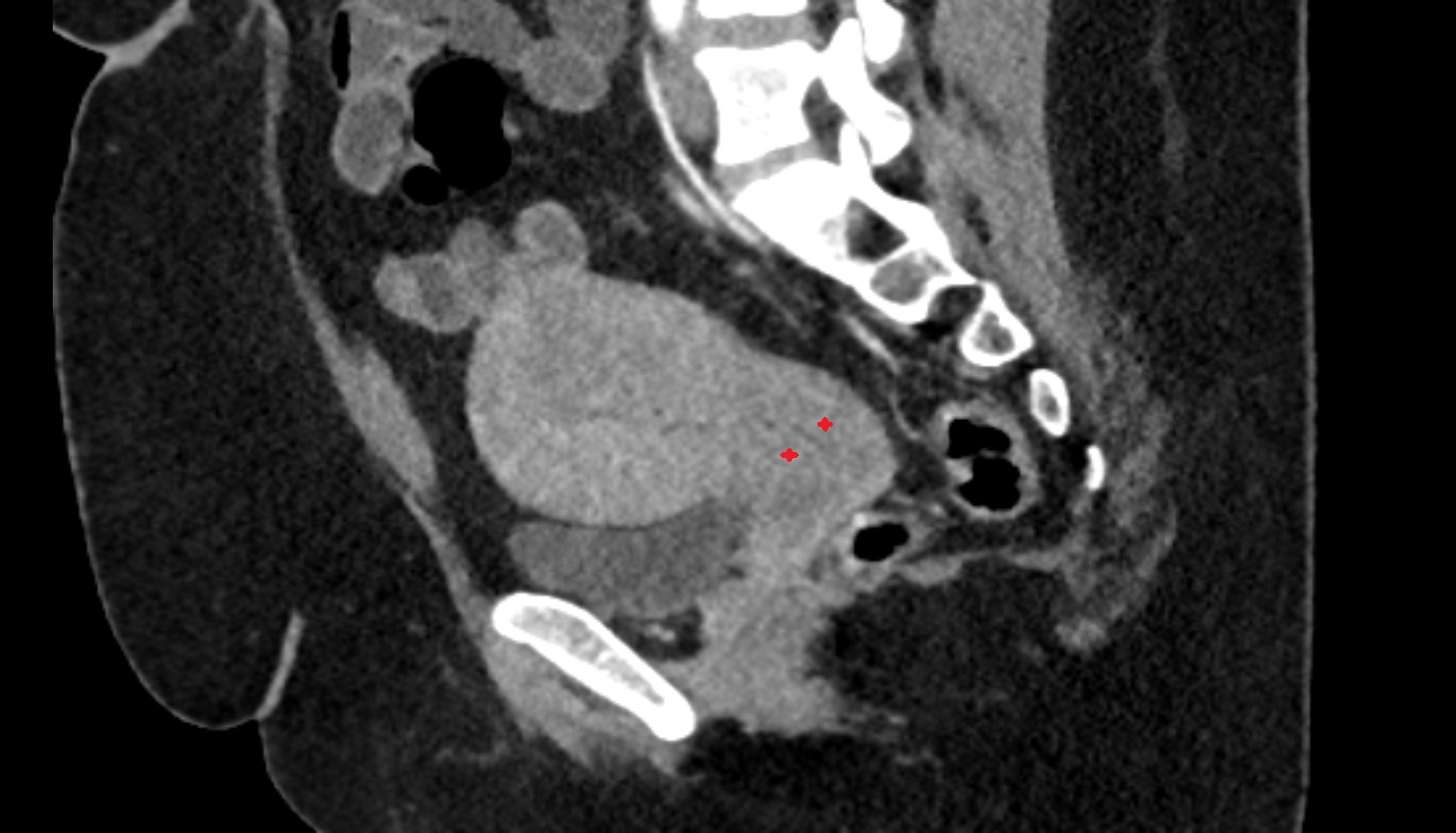 Stroma of the cervix  ct  sagittal  anatomy  image-img-00000-00000