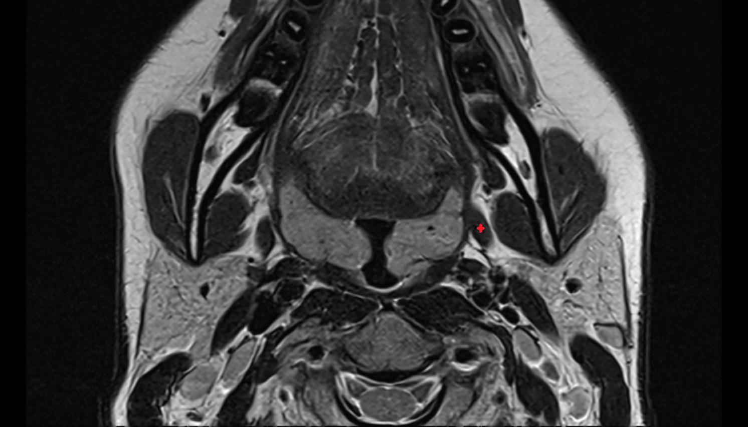 Styloglossus muscle mri axial image -img-00000-00000