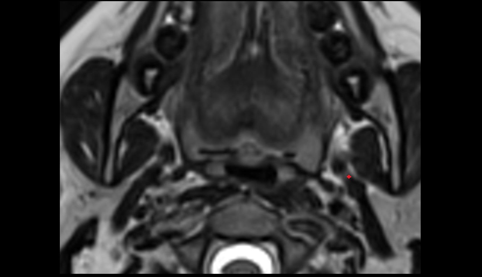 Stylohyoid muscle mri axial image