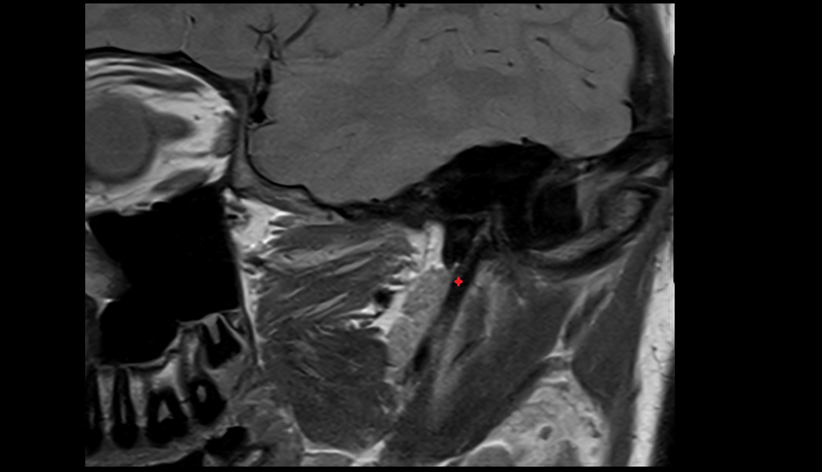 Styloid process of temporal bone mri