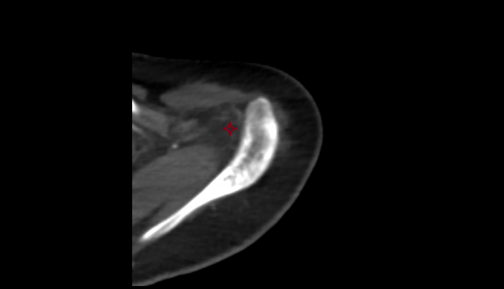 Subacromial space ct axial