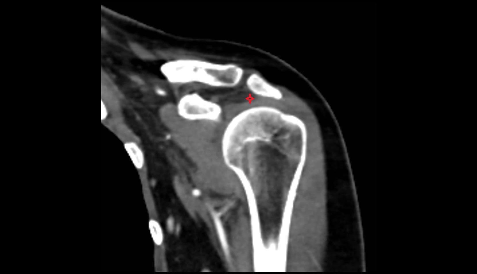 Subacromial space ct coronal