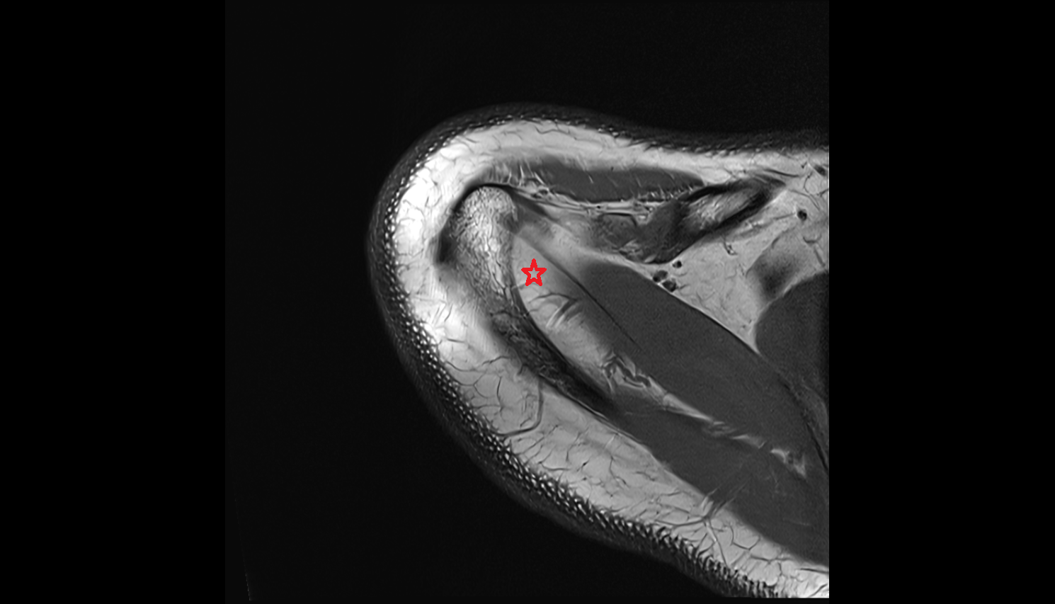 Subacromial space shoulder axial cross sectional anatomy 3T MRI AI enhanced radiology image-img-00000-00000