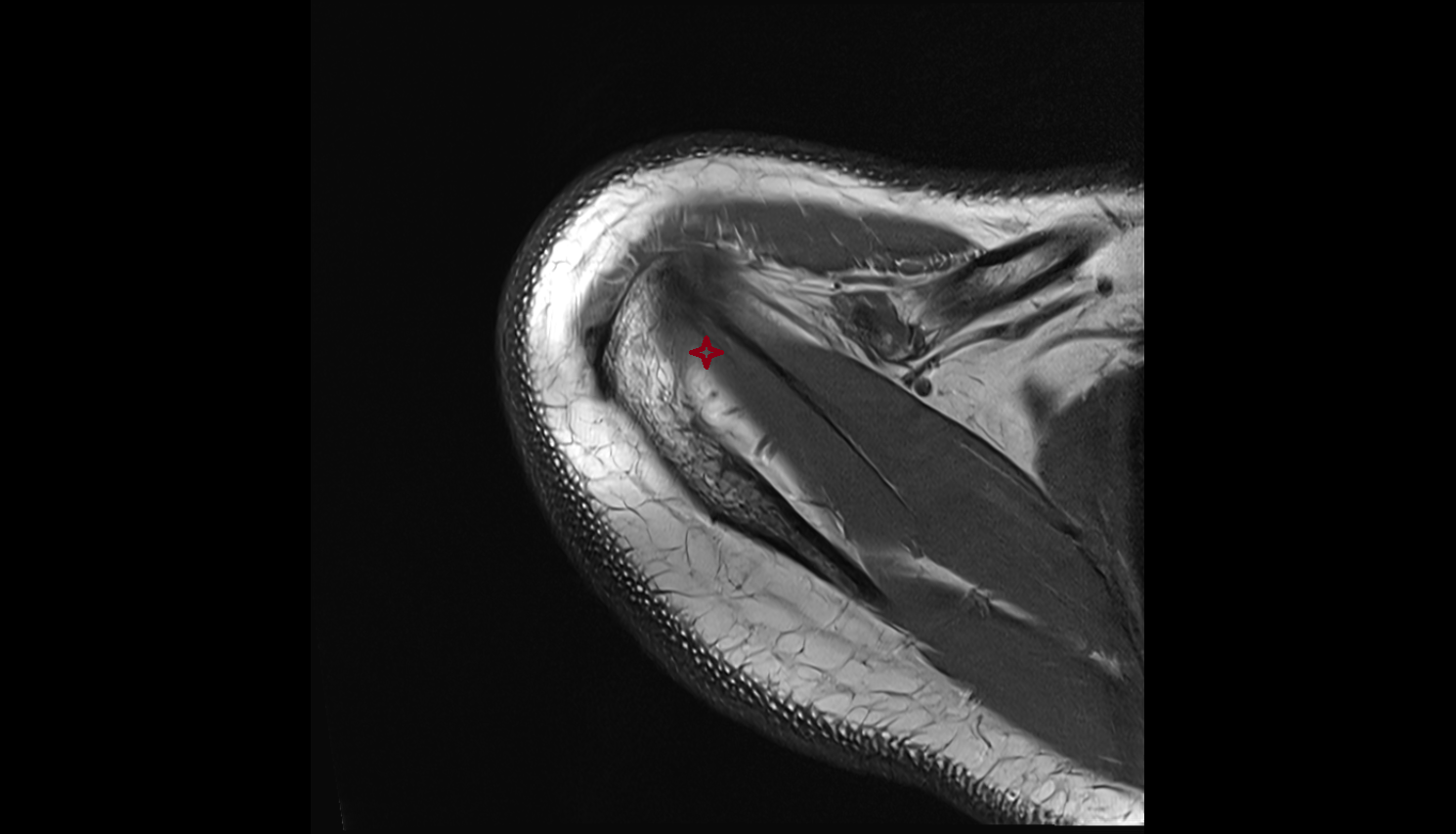 Subacromial space shoulder axial cross sectional anatomy 3T MRI AI enhanced radiology image-img-00000-00000_00001