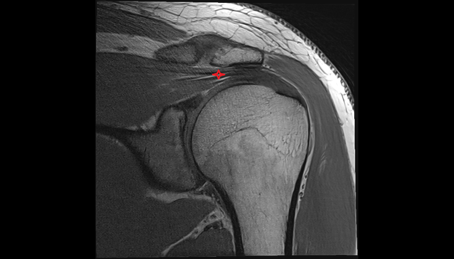 Subacromial space shouldercoronal cross sectional anatomy 3T MRI AI enhanced radiology image-img-00000-00000