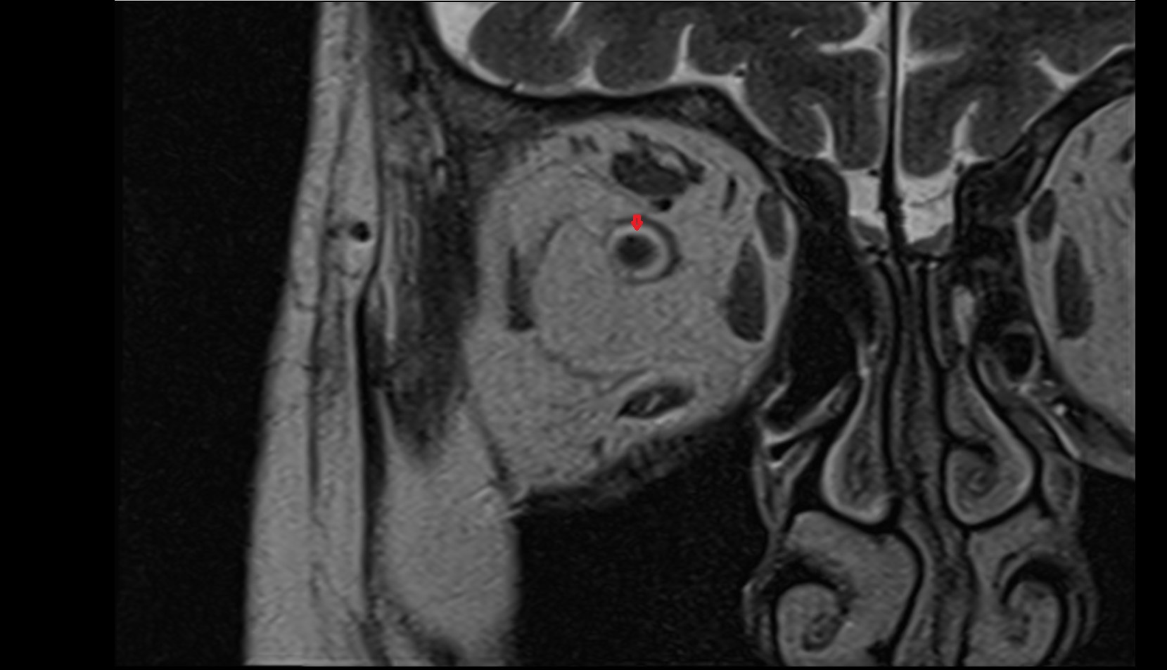 Subarachnoid space orbits mri image