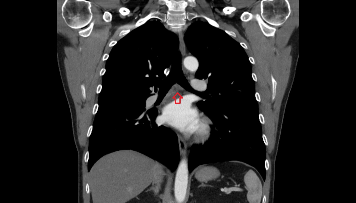 Subcarinal Lymph nodes  anatomy CT coronal  image -img-00000-00000