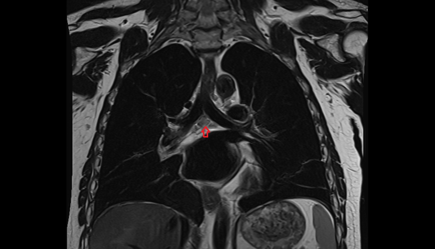 Subcarinal Lymph nodes  anatomy mri coronal  image -img-00000-00000