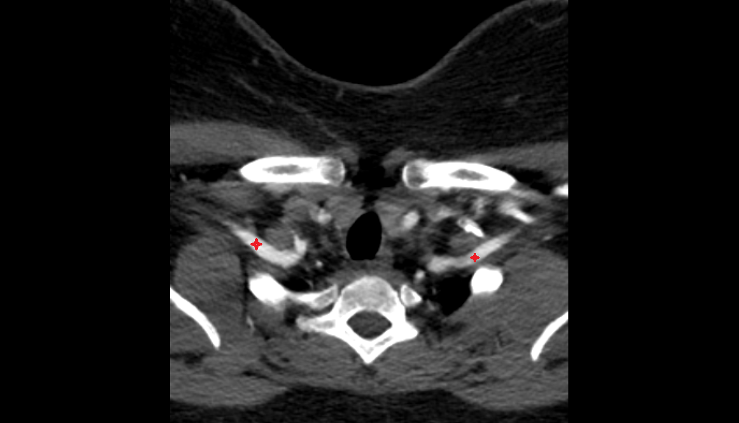 Subclavian artery CT axial  image-img-00000-00000