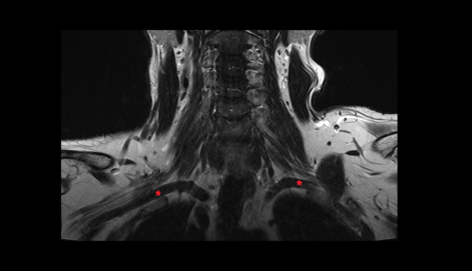 Subclavian artery MRI CORONAL IMAGE
