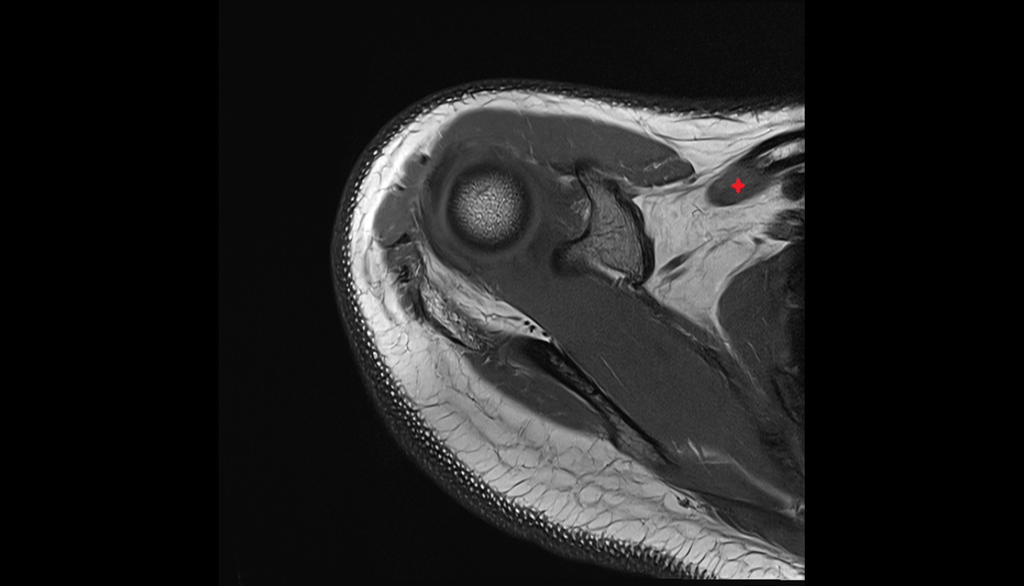 Subclavius muscle  axial cross sectional anatomy 3T MRI AI enhanced radiology image-img-00000-00000