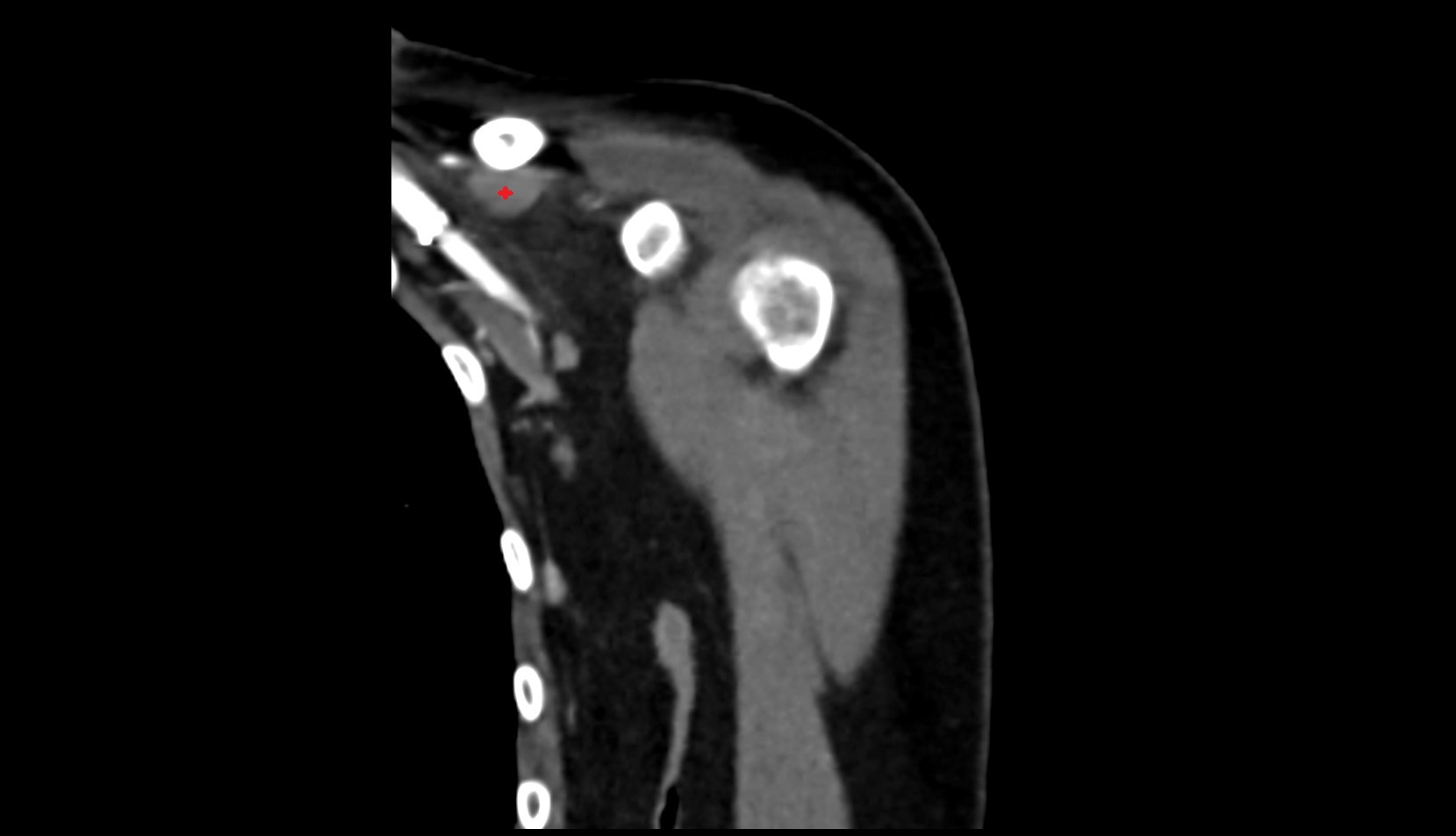 Subclavius muscle ct