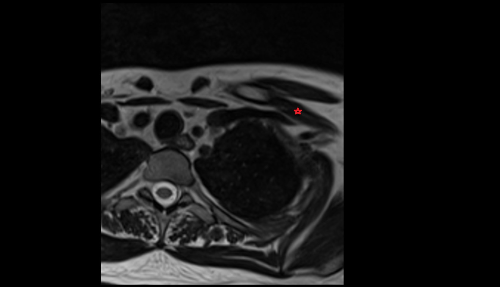 Subclavius muscle mri axial image