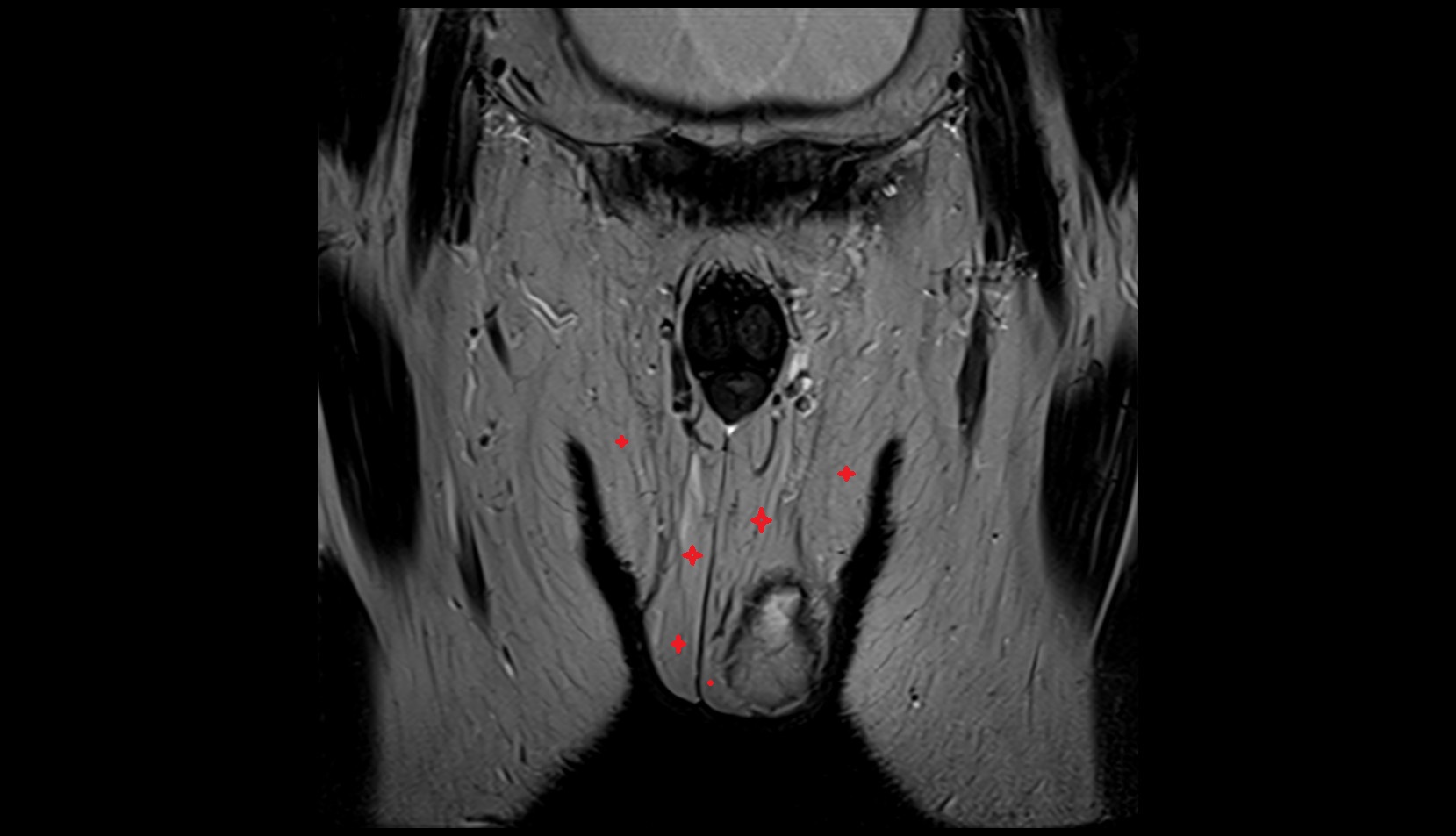Subcutaneous tissue of pelvis