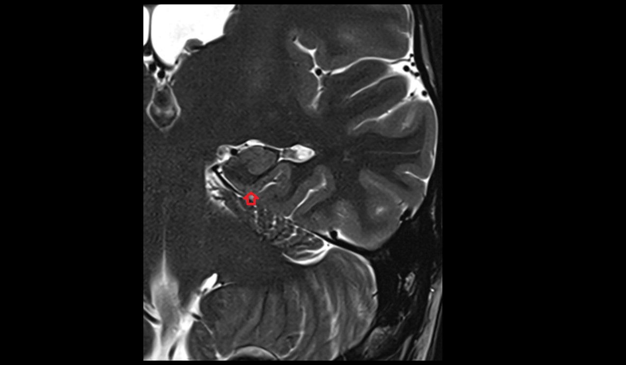 Subiculum mri 3t coronal image