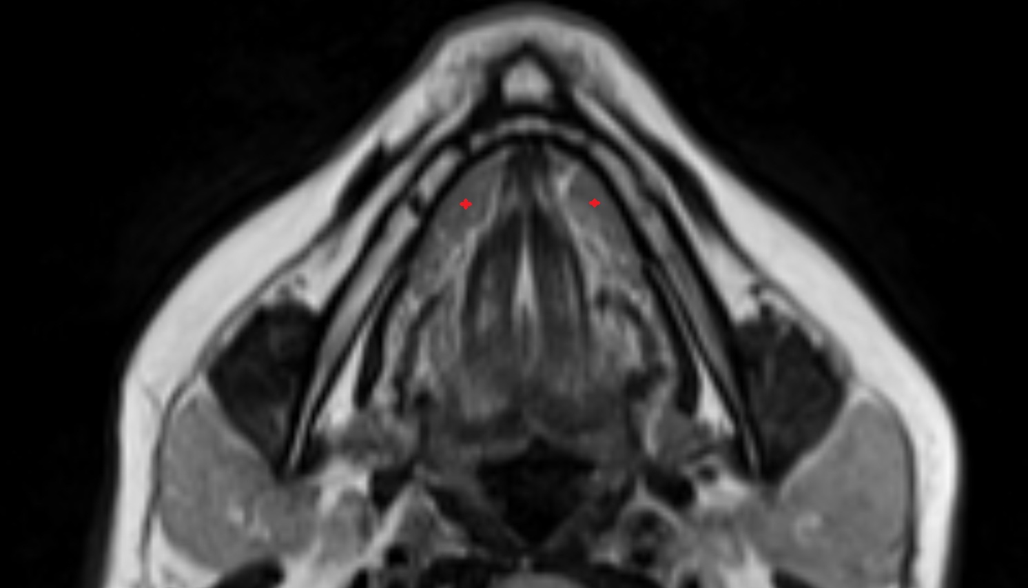 Sublingual Gland  mri axial image -img-00000-00000