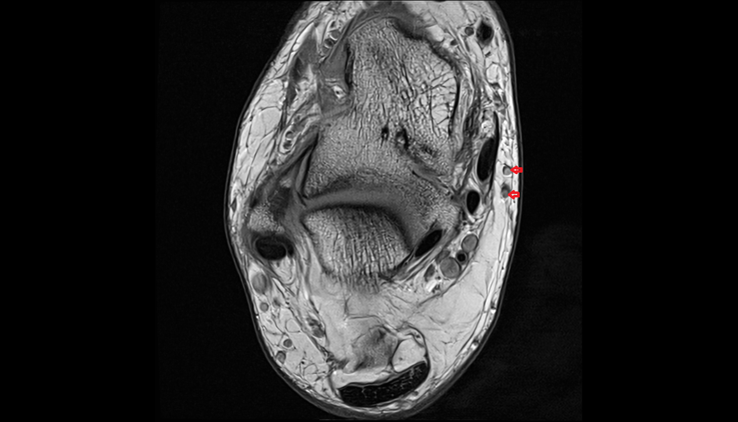 Submalleolar foot perforator veins veins  AXIAL  cross sectional anatomy 3T MRI AI enhanced radiology image-img-00000-00000